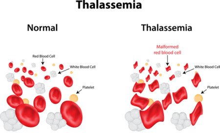 thalassemia-| health