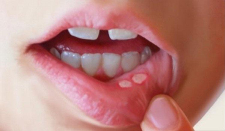 home-remedies-for-mouth-ulcers