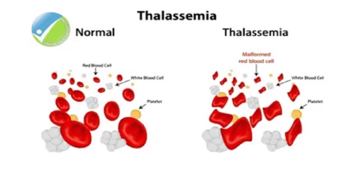 Thalassemia D