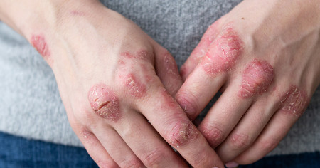 psoriasis hand 2