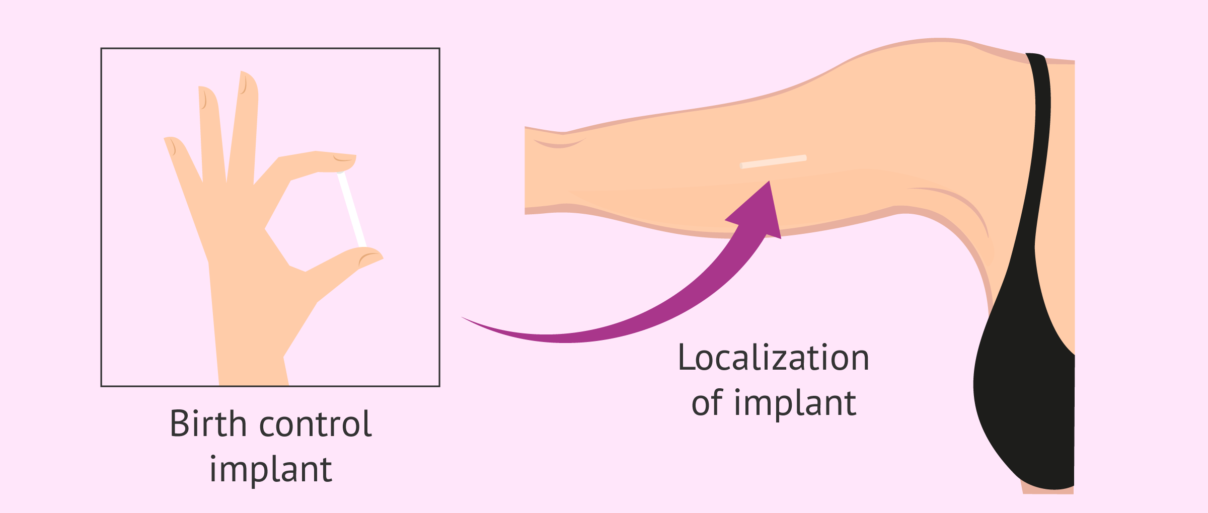 localization birth control implant