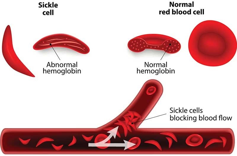 What is sickle cell anemia, a serious blood disease? Do not ignore the symptoms otherwise you may die.