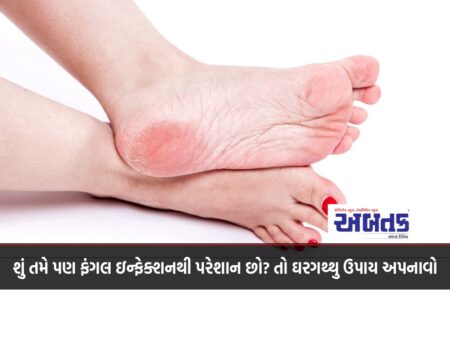 Are you also suffering from a fungal infection? So adopt home remedies