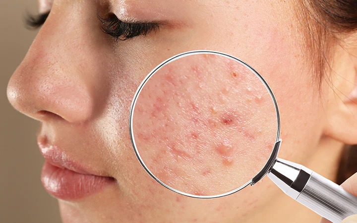 Pimples appear on the face even after makeup? So follow these tips