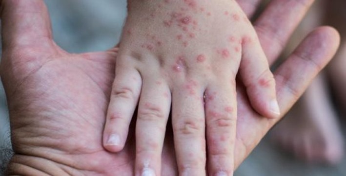 Has the monkeypox virus spread to children? Know the cause and symptoms of its spread