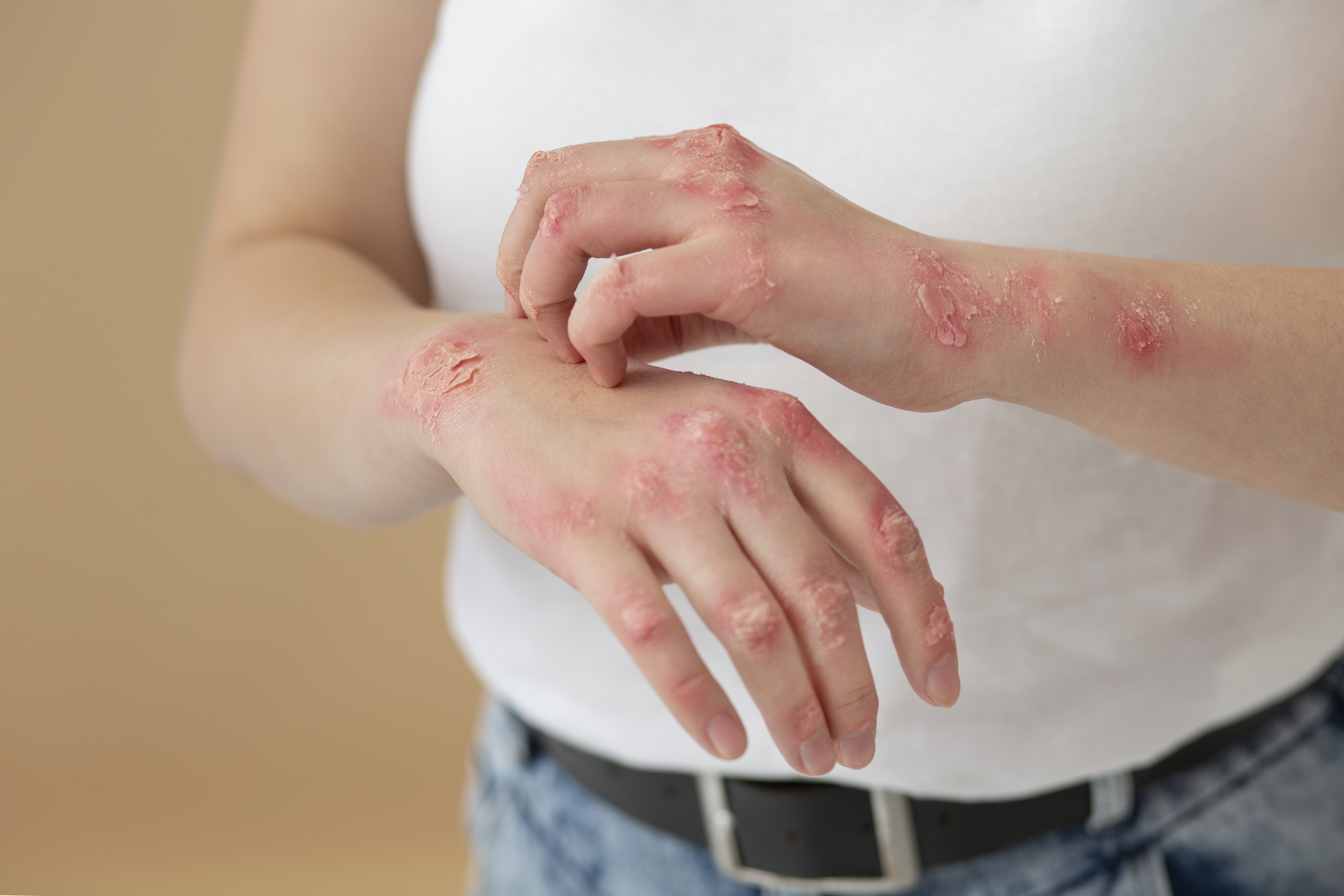 World Psoriasis Day : Psoriasis problem occurs for these reasons, know its symptoms and treatment