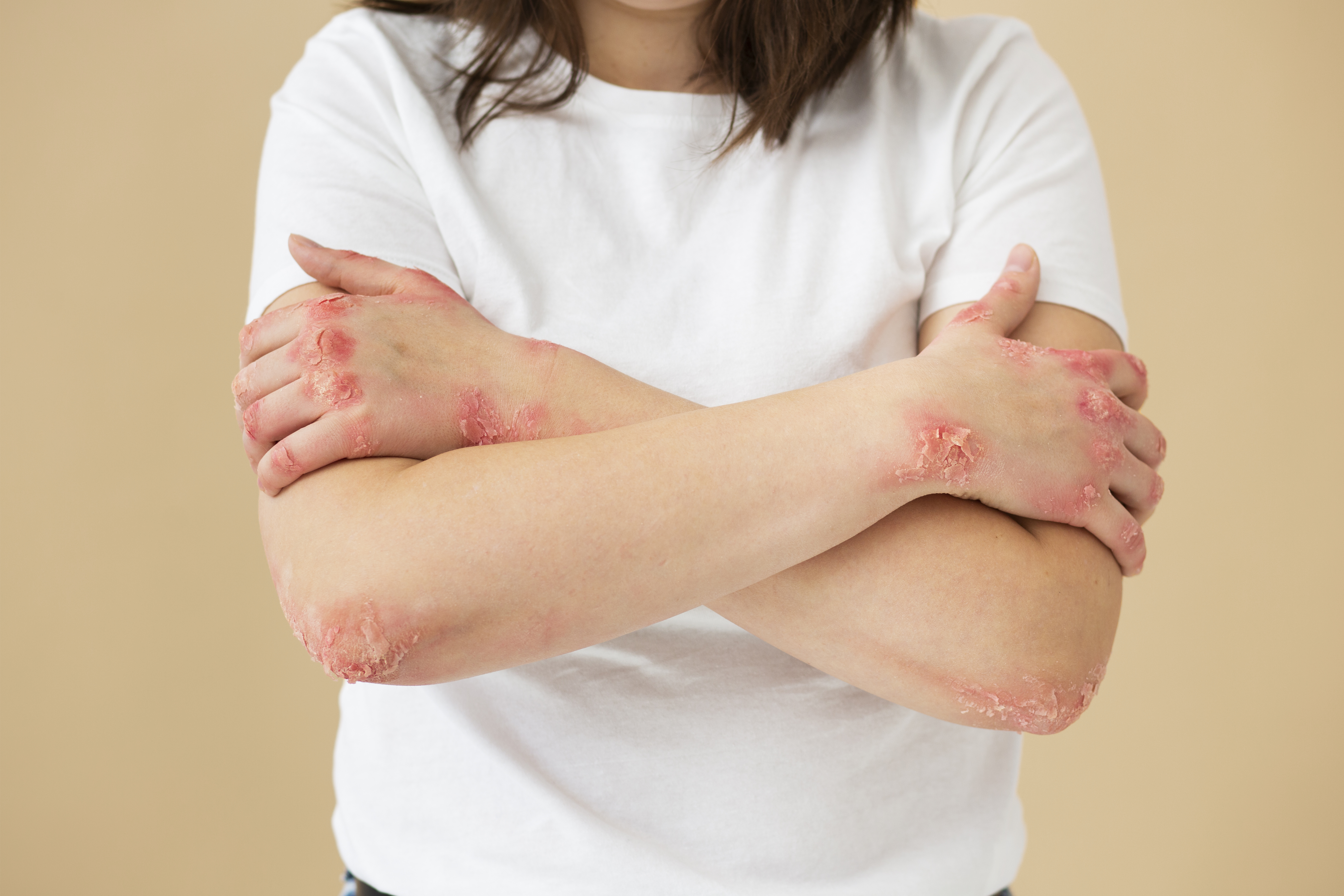 World Psoriasis Day : Psoriasis problem occurs for these reasons, know its symptoms and treatment