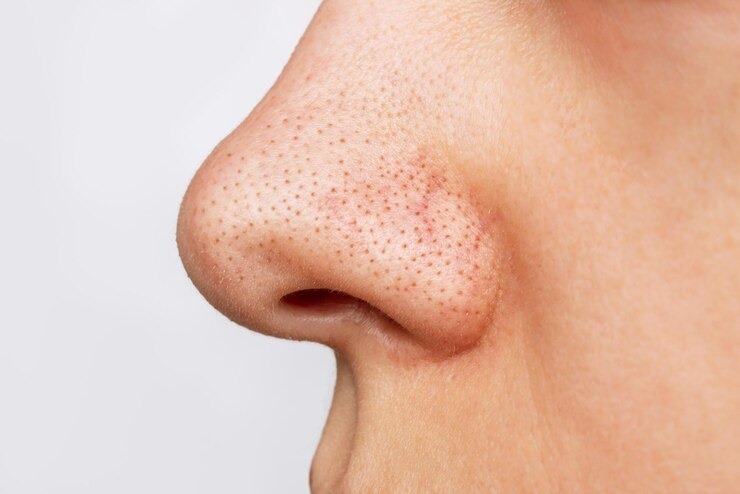 Even stubborn blackheads will disappear overnight, try this home remedy