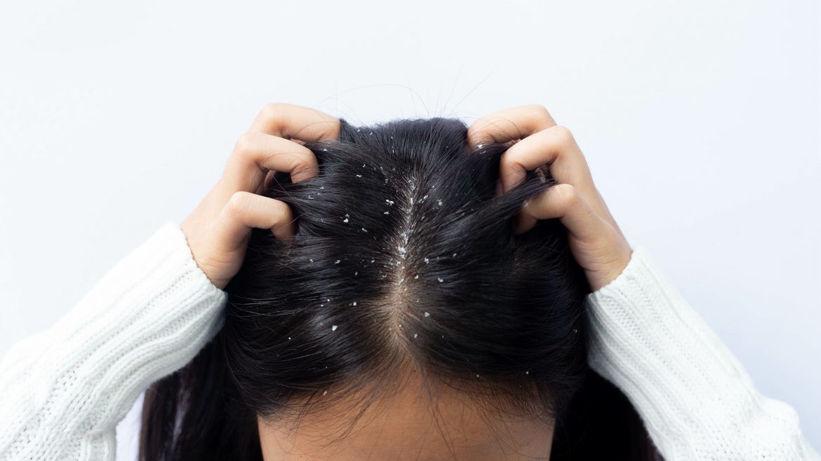 Are you troubled by dandruff and hair loss in winter? Then adopt these special hair care tips and you will get benefits.